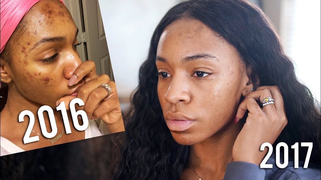 CLEAR SKIN ALL YEAR! Skincare Routine + 2017 Fav Products 