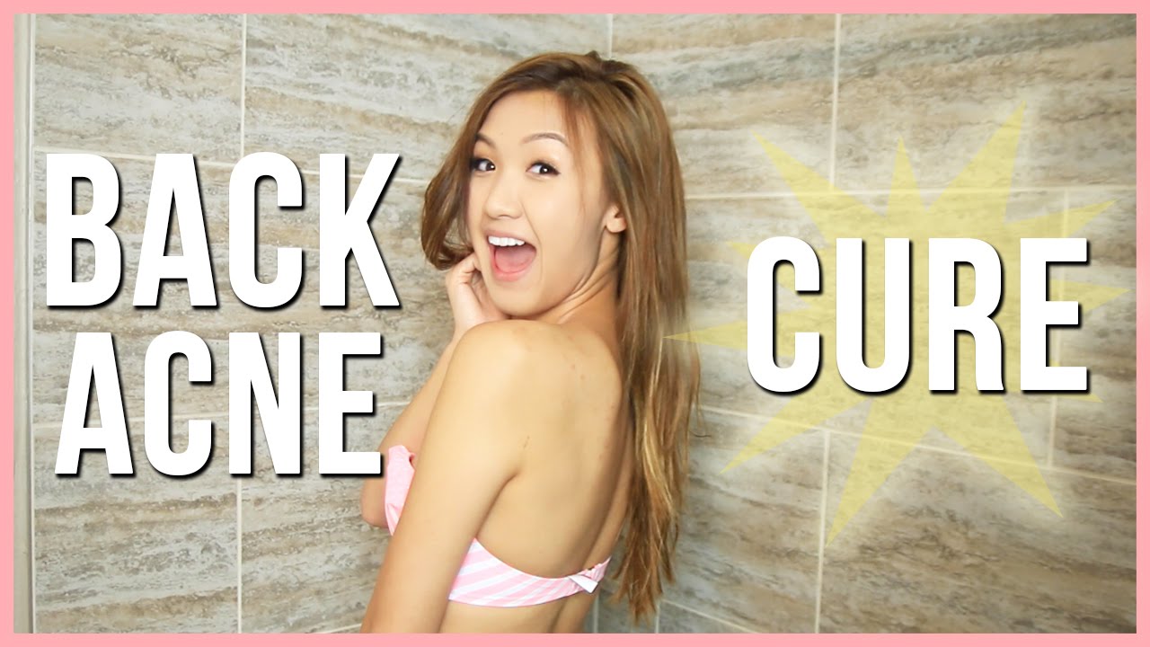 My Back Acne Cure!  ilikeweylie – Beauty Never Fades